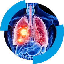 Explosão por poeira combustível