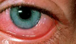 As partículas da névoa de óleo podem se depositar na pele e nos olhos durante o trabalho e provocar enfermidades como: Dermatites; Conjuntivites  | Saiba mais | Nederman