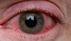 Nos olhos a poeira pode provocar irritações conhecidas como conjuntivite, lesionar a córnea e outros componentes da anatomia ocular | Nederman