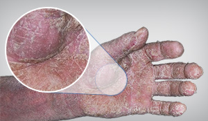 Além dos problemas de pele, escorregões, quedas e dos incômodos do barulho, um dos riscos mais importantes para prejudicar a saúde dos profissionais que lidam com a usinagem de metais é a — inalação das partículas metálicas. Saiba mais | Nederman