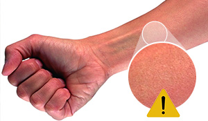 Queiradura por esposição prolongada a solda. Perigos para a saúde e a segurança associados à solda | NEderman 