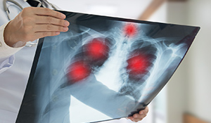 Particulado respirável: É a fração de material particulado suspenso no ar constituída por partículas de diâmetro aerodinâmico menor que 10μm, capaz de penetrar além dos bronquíolos terminais e se depositar na região de troca de gases dos pulmões, causando efeito adverso nesse local | Nederman