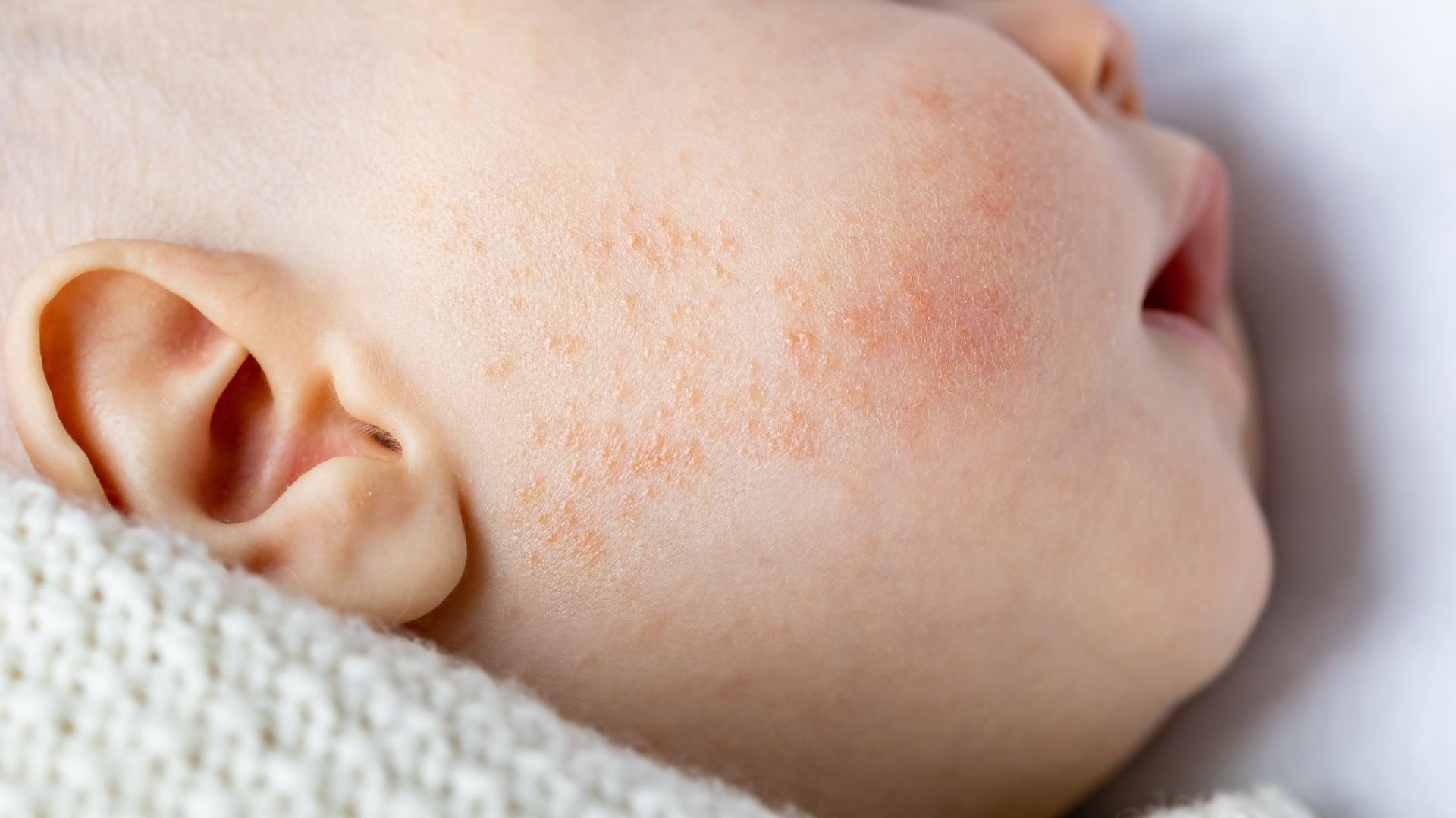 baby-acne