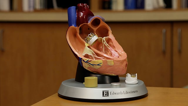 A model of the human heart showing the placement of the transcatheter aortic valve replacement (TAVR) 