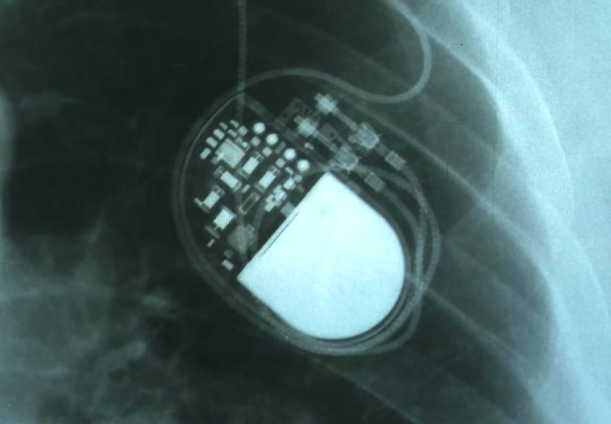 A xray showing the placement of a pacemaker 