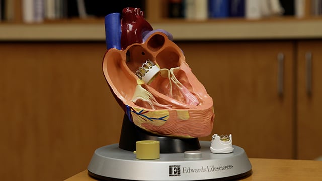 A model of the heart showing the placement of the TAVR device