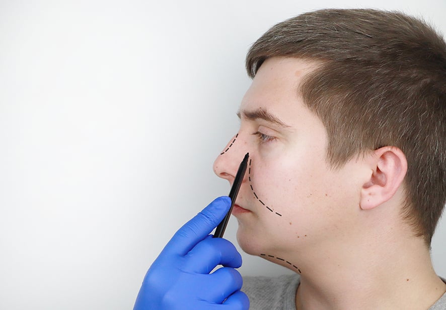 A medical professional marking a male patient for Rhinoplasty (nose job)