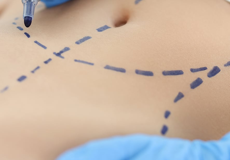 A patient being marked for a tummy tuck procedure 