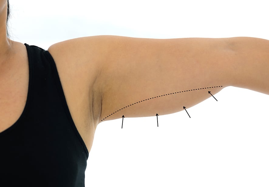 A patient with lines on her arm to prepare for a brachioplasty