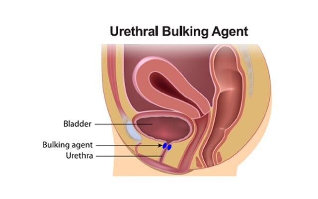 A graphic showing the anatomy of a woman and the placement of the Bulkamid treatment