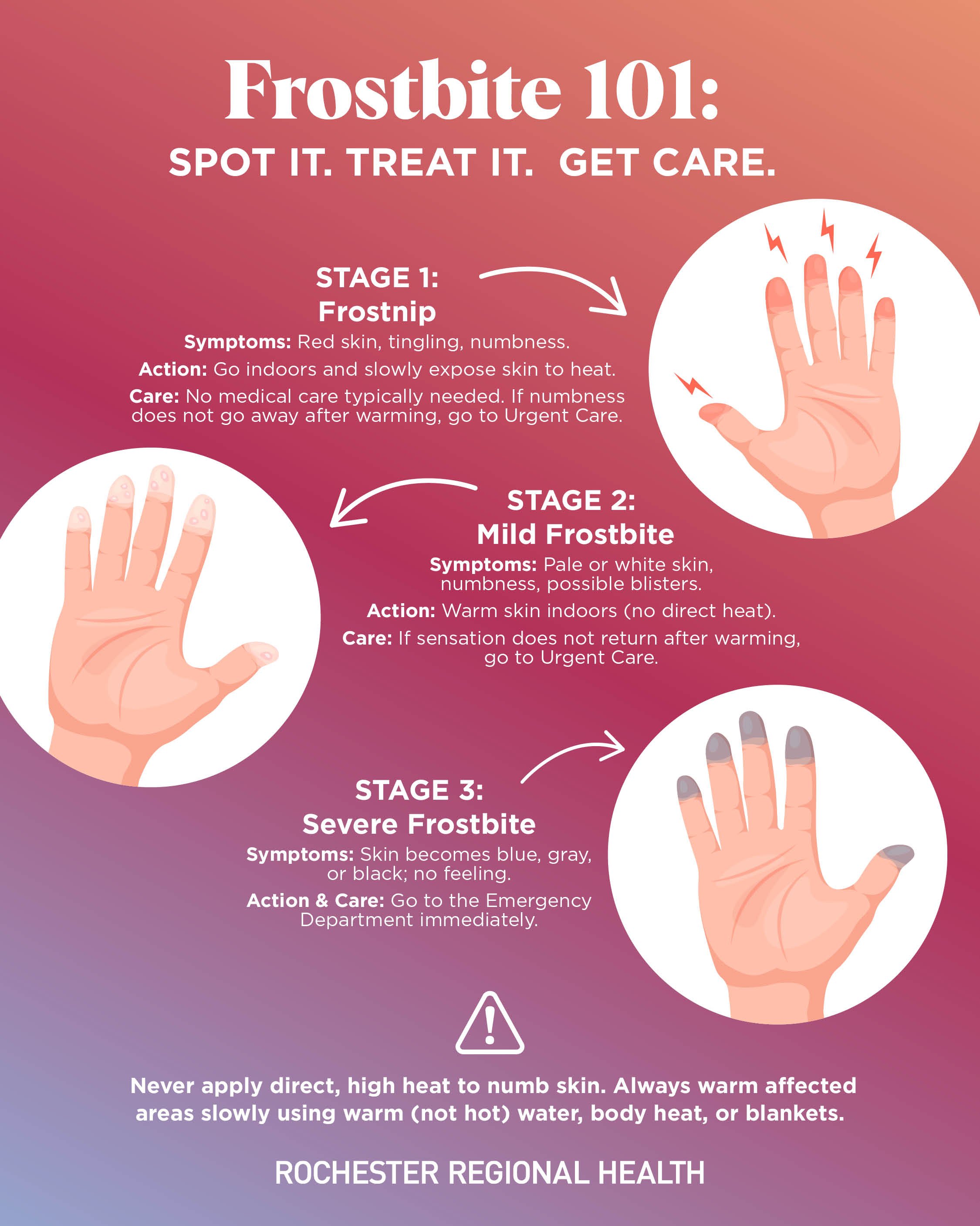Illustration showing the various stages of frostbite and how to treat them