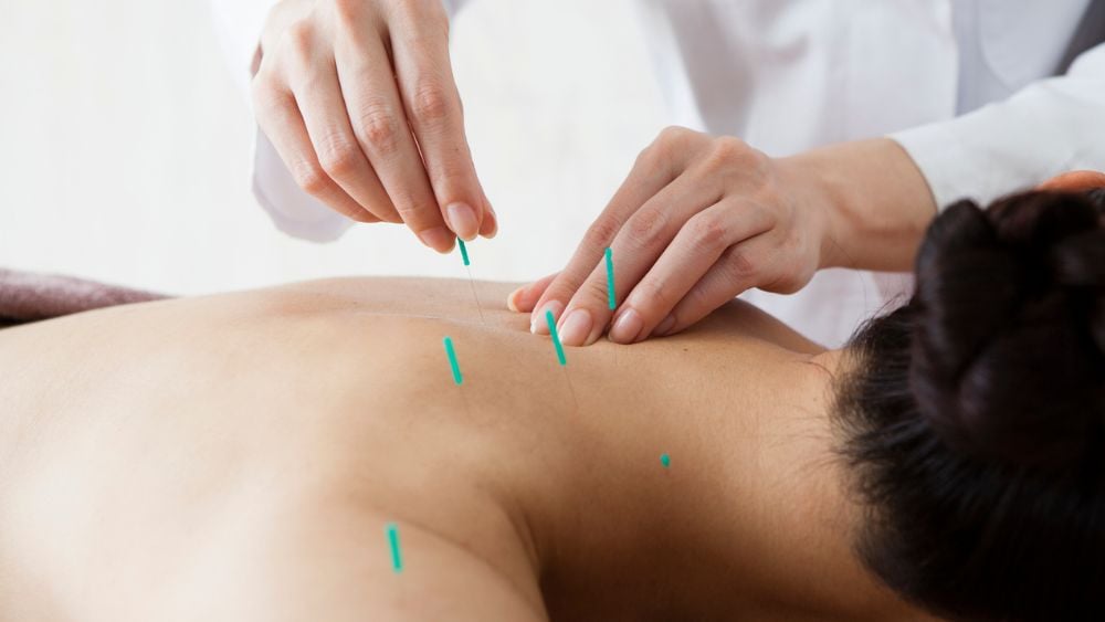 Patient receiving acupuncture on upper back