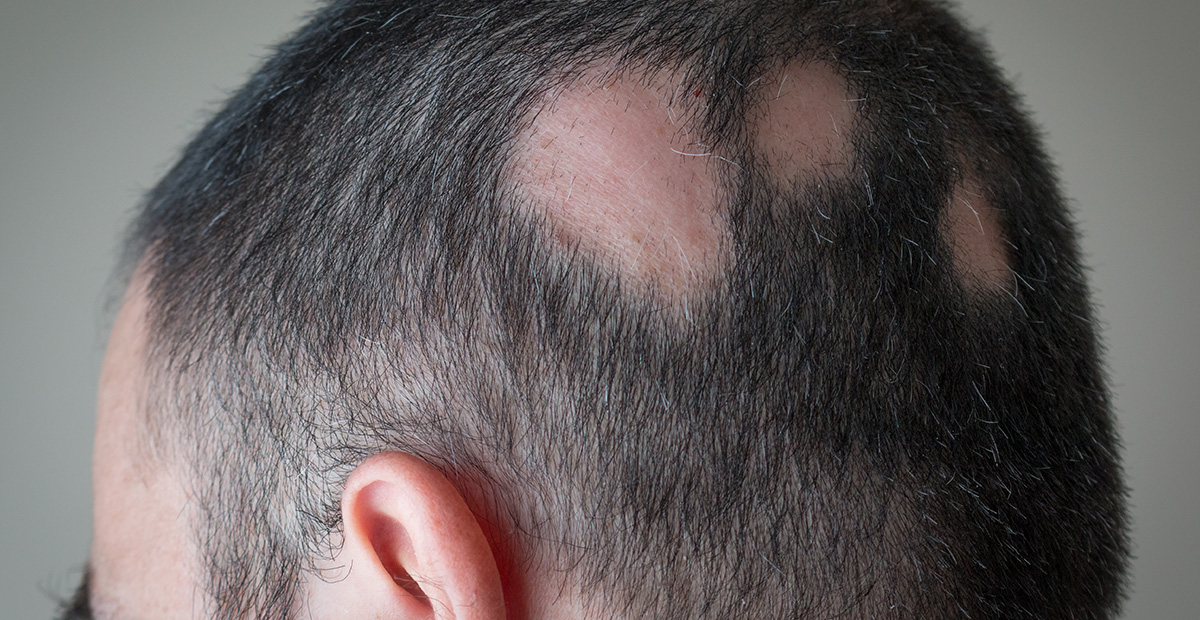 A white man with alopecia areata has circular patches of missing hair on the back of his head