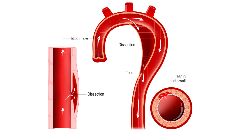 Medical illustration of aortic dissection