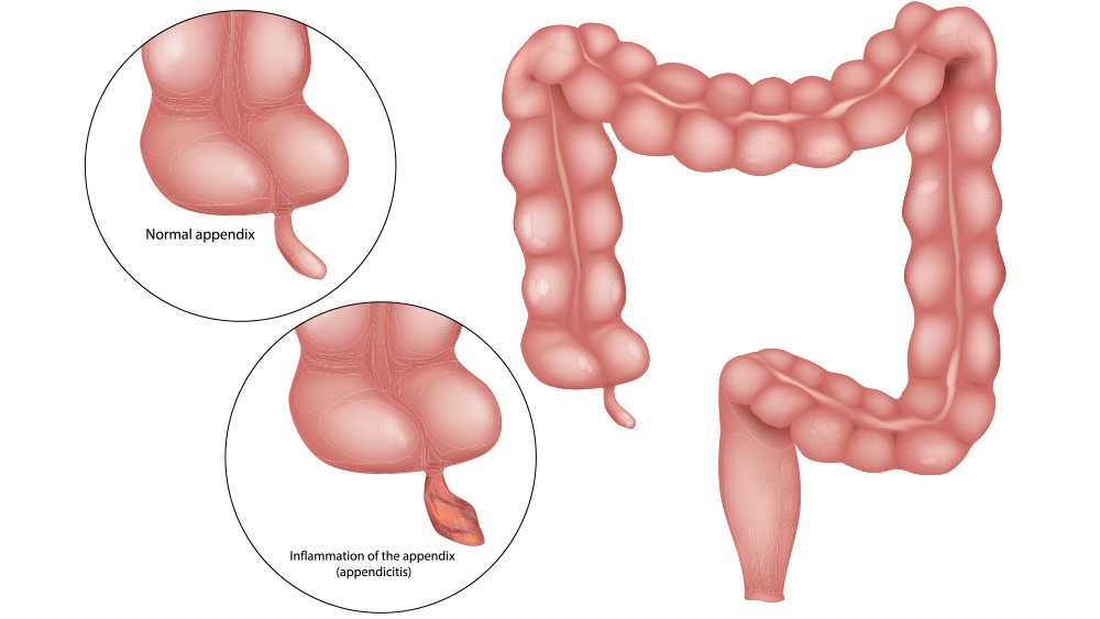 Medical illustration of large intestine with normal appendix and inflamed appendix