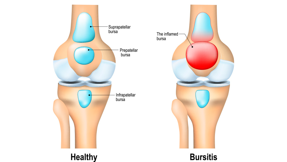 Bursitis illustration