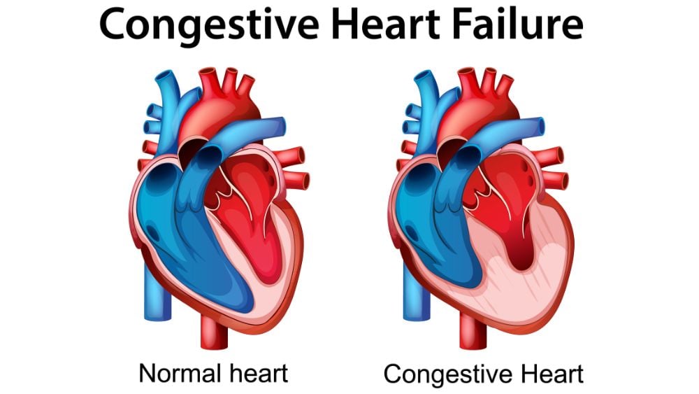 Medical illustration of congestive heart failure with normal heart and congestive heart diagrams