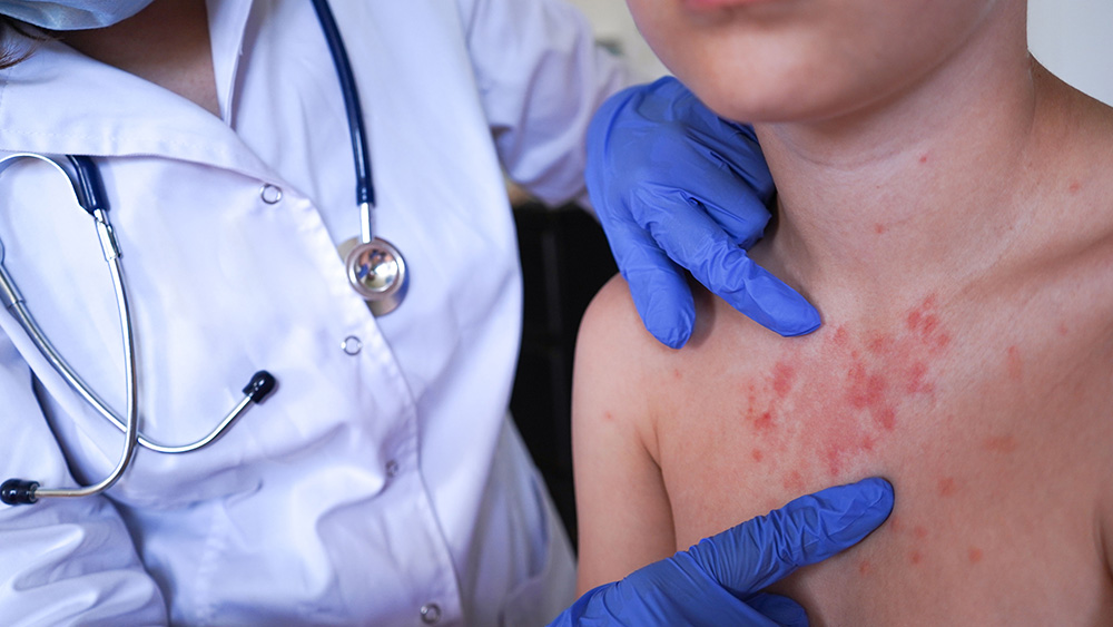 Contact dermatitis