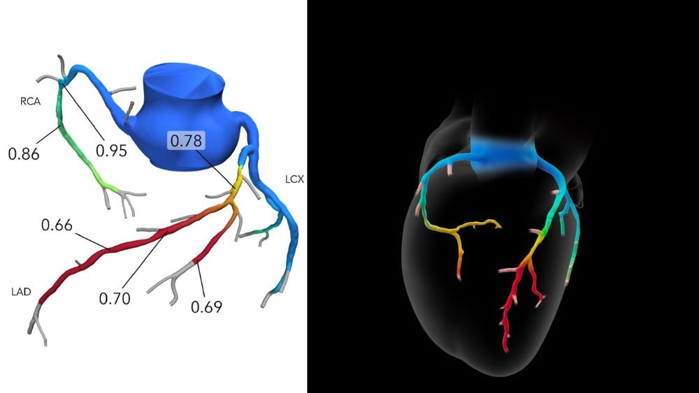 CT FFR images of HeartFlow technology
