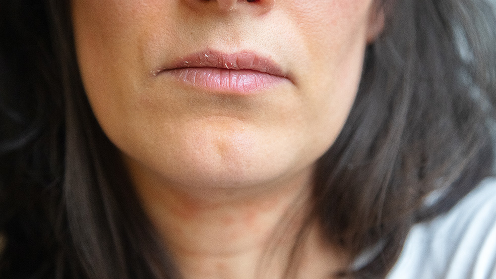 Woman with dry chapped lips