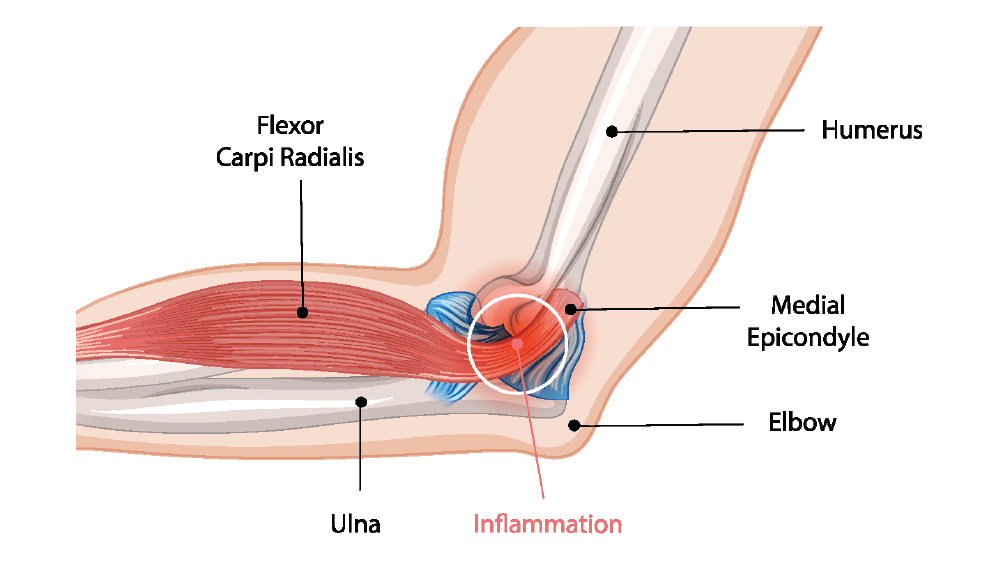 Medical illustration of media epicondylitis