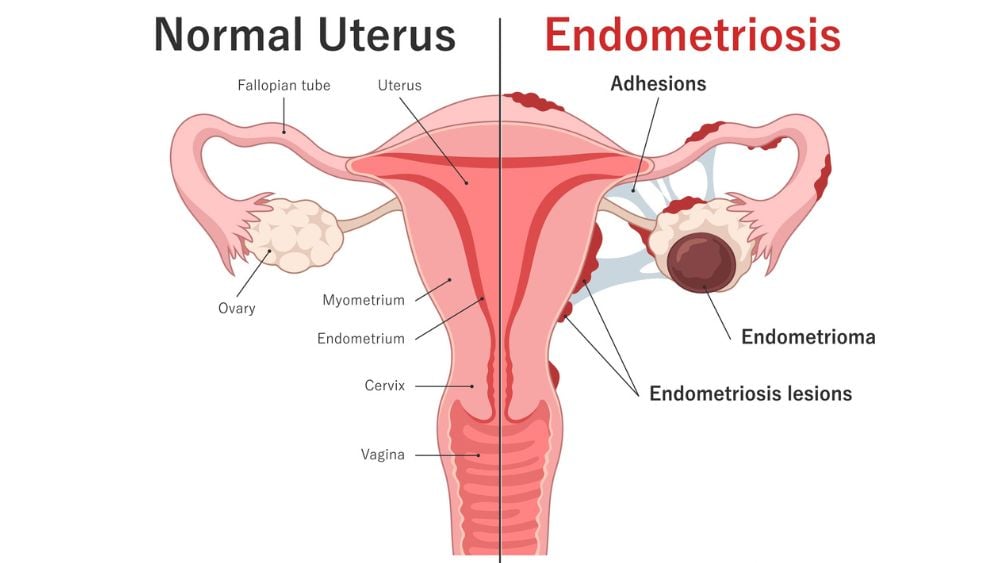 Medical illustration of a normal uterus compared to a uterus with endometriosis