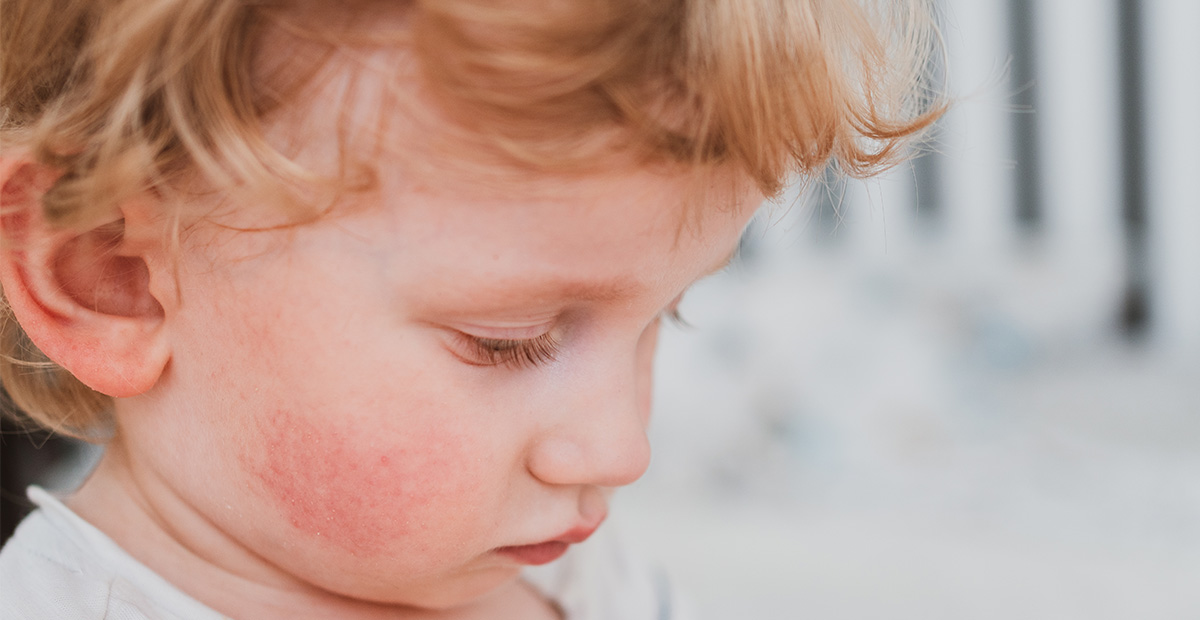 A young white child with a red rash on his cheek
