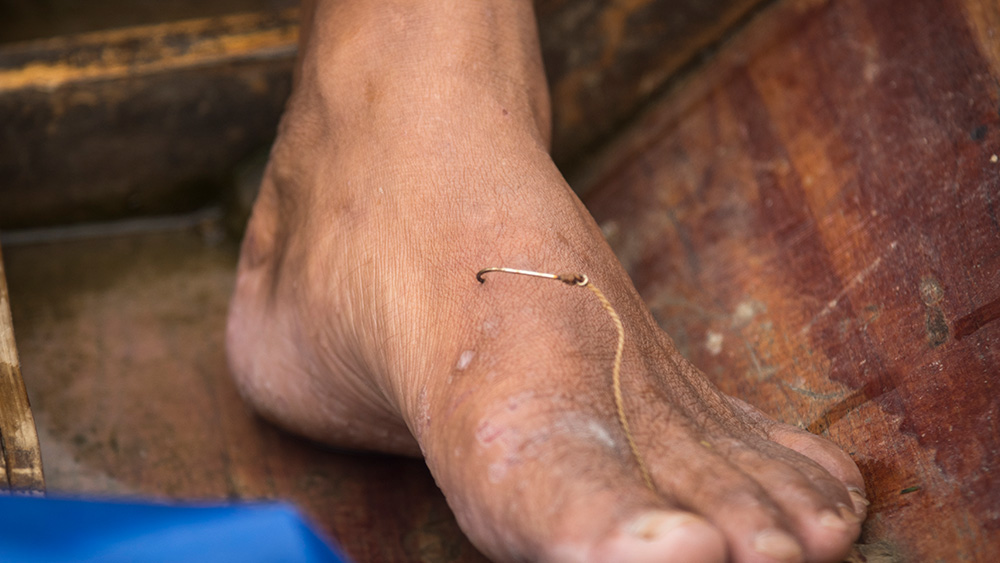 fish hook embedded in foot