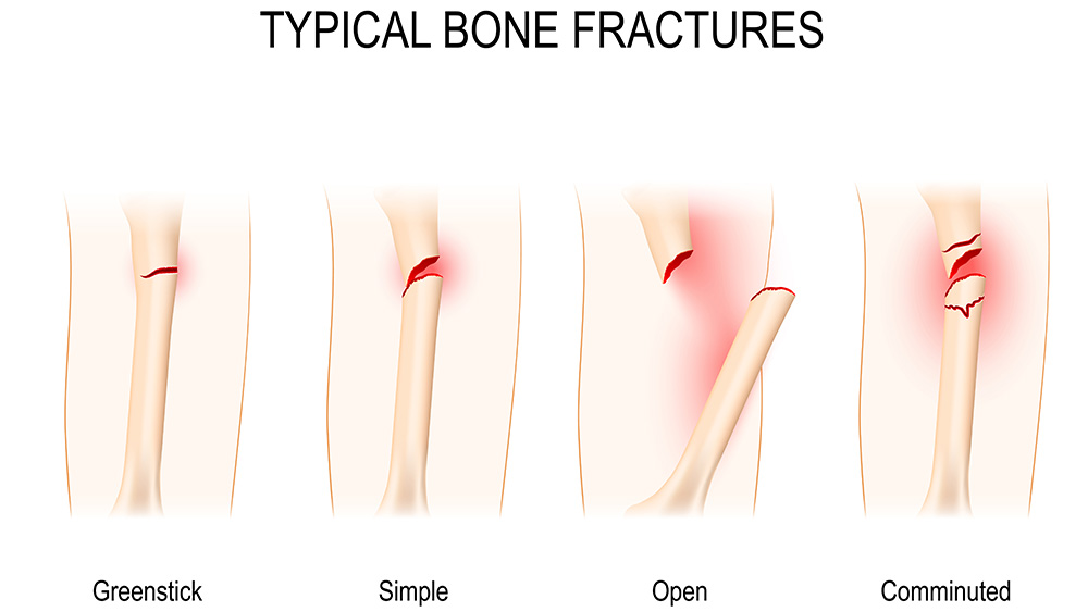 Typical bone fractures. Green stick, simple, open, and comminuted fractures