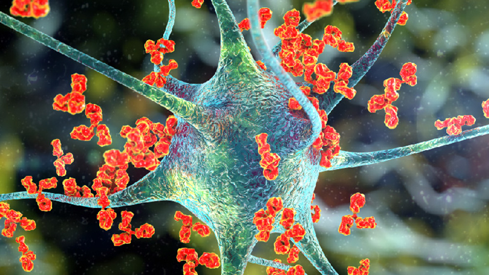 Guillain Barre syndrome