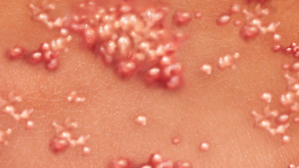 Herpes simplex virus image