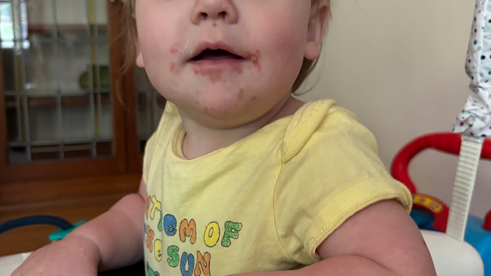 adorable baby with hand foot and mouth disease rash around mouth grateful dead bear onesie