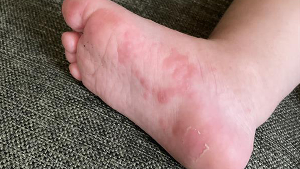 toddler foot with hand foot and mouth disease rash