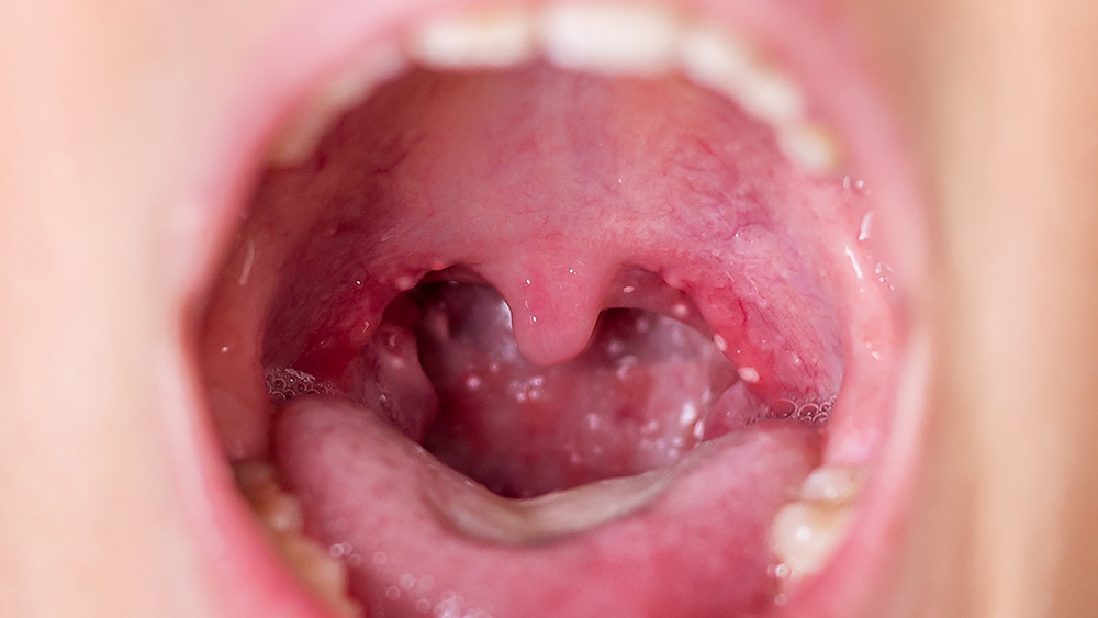 Coxsackie virus in a child. Variety of enterorovirus, herpangina