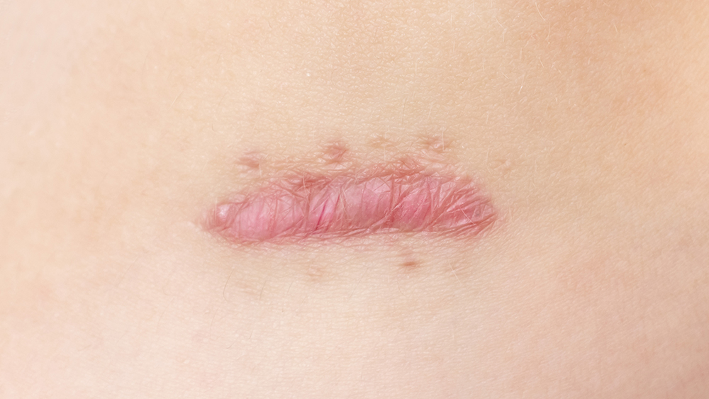 reddened welt scar on white skin