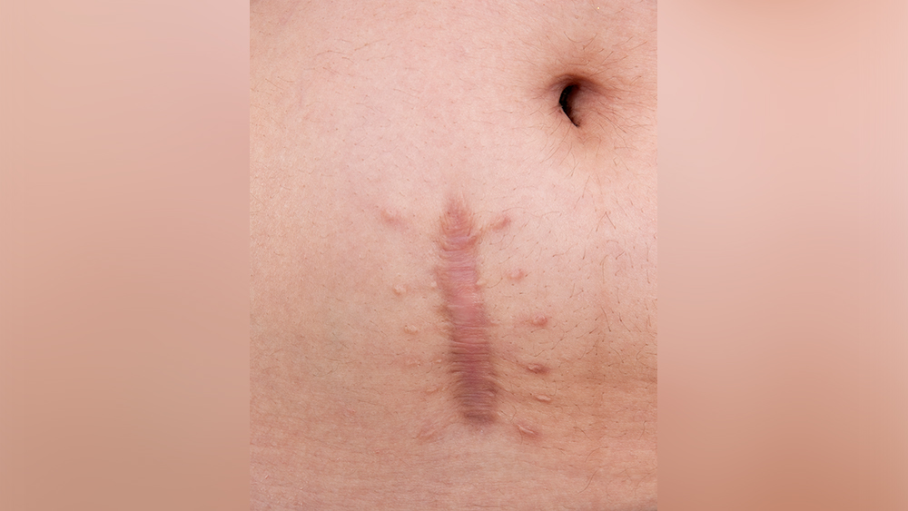 keloid scar on white skin