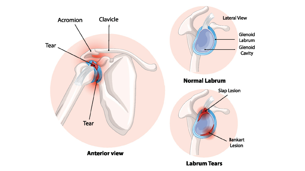 Medical illustration of labrum tear