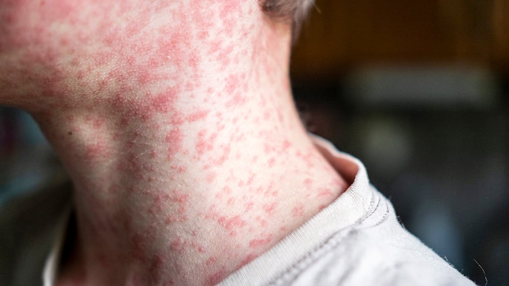 Child with measles rash