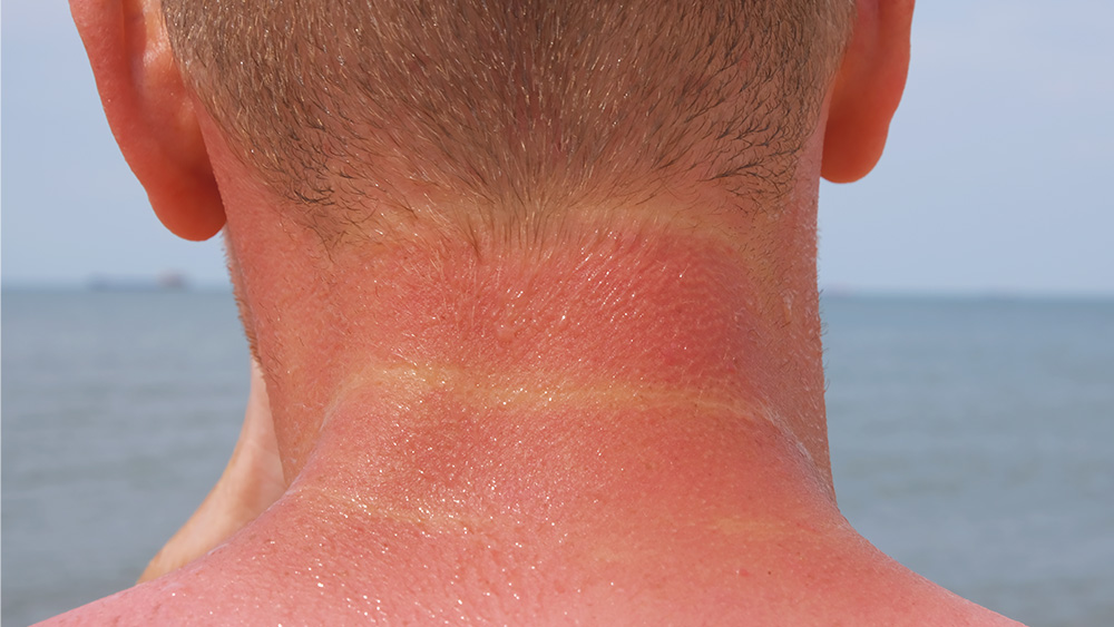 Man with mild sunburn on neck