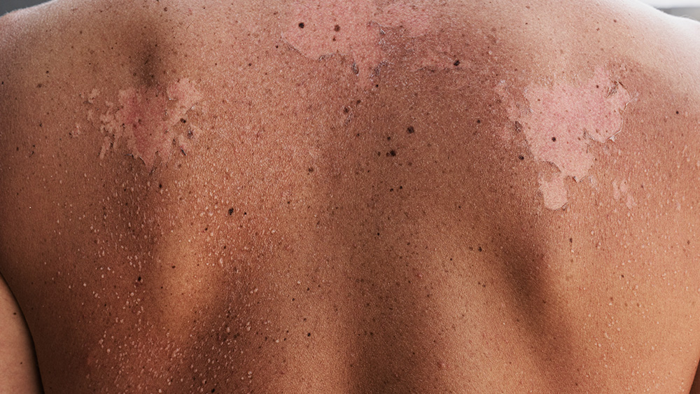 Teenage boy with moderate sunburn