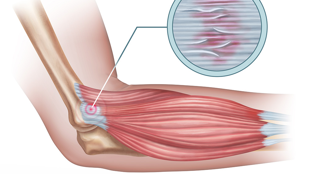 Pickleball elbow illustration