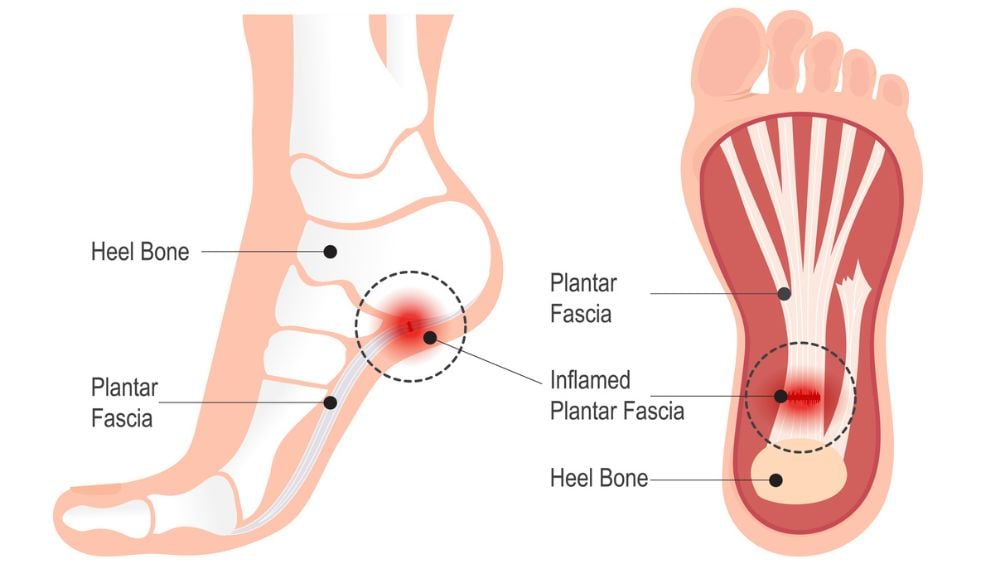 Medical illustration of plantar fascia