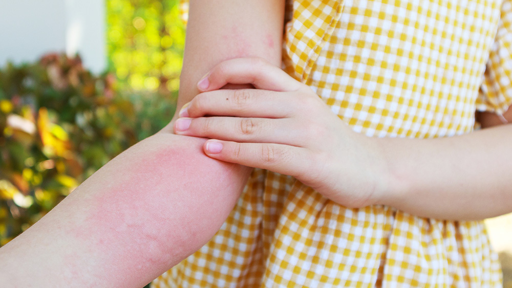 Little girl has skin rash allergy and itchy on her arm
