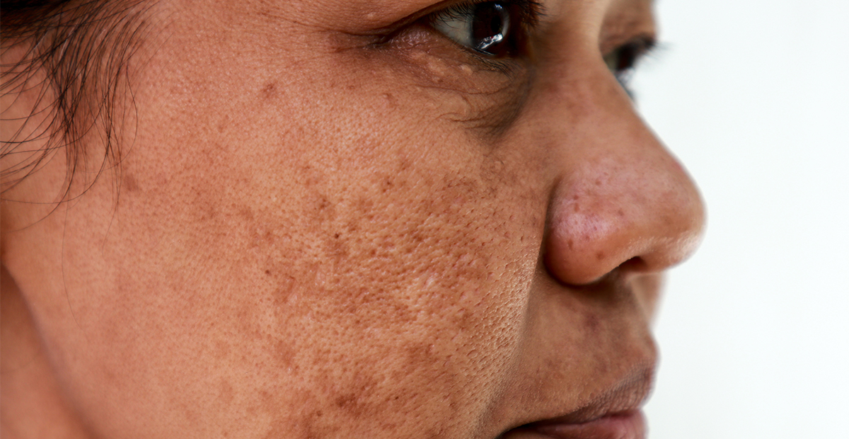 Asian woman with melasma