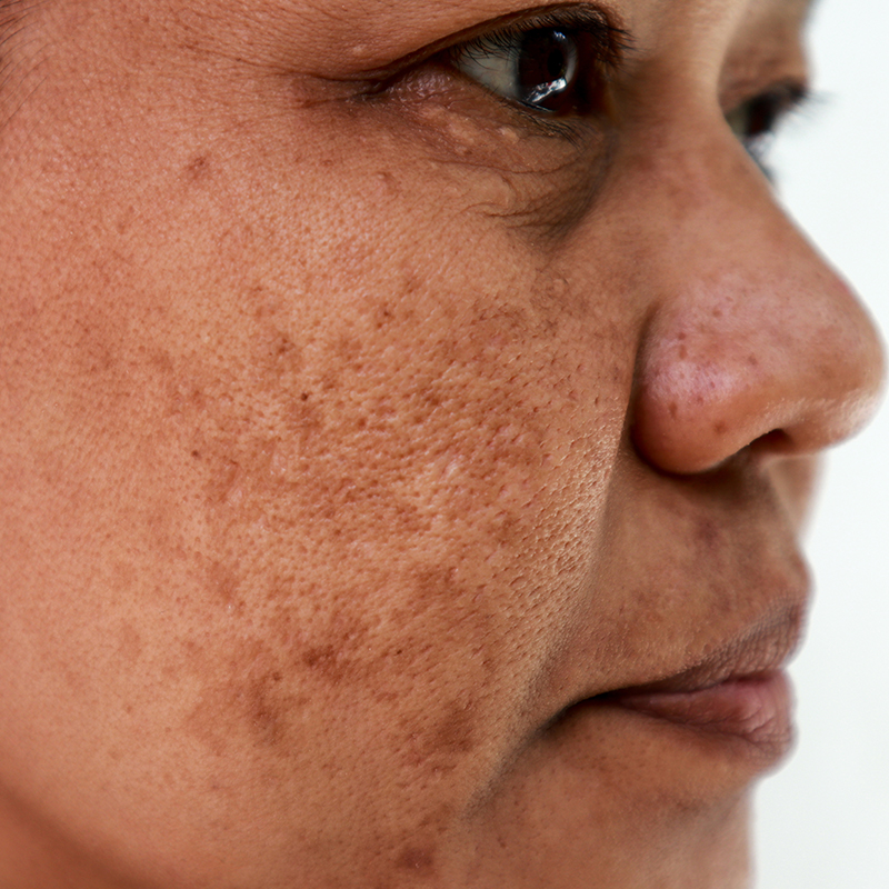 Asian woman with melasma
