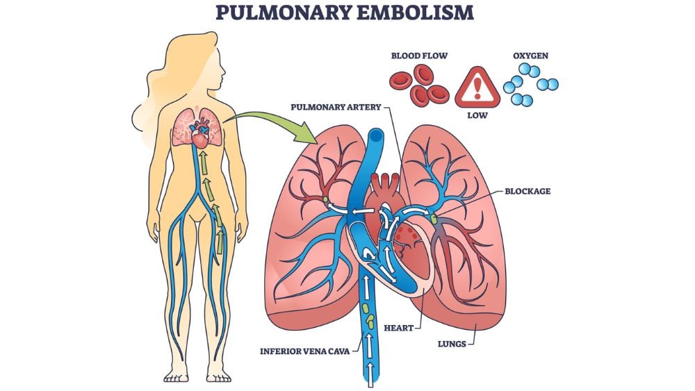 Medical illustration of pulmonary embolism