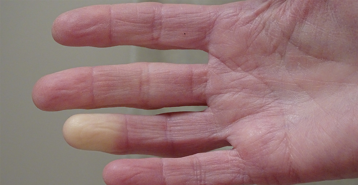 Adult hand with Raynaud’s Syndrome