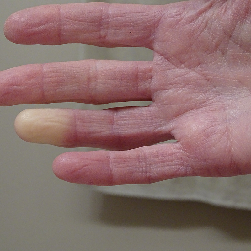 Adult hand with Raynaud’s Syndrome