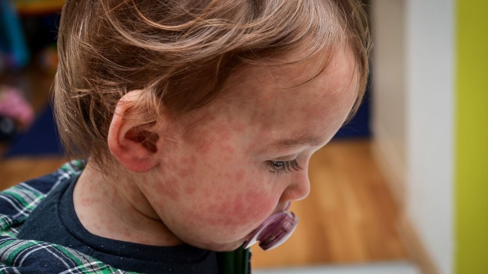 Toddler with measles on face