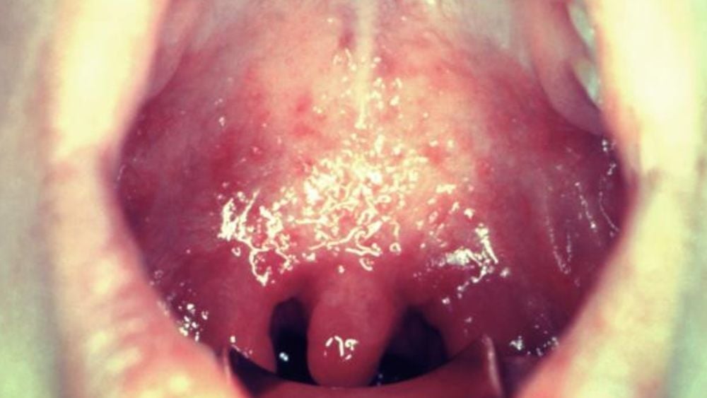 Photo of child's mouth with Koplik spots